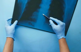 A New AI Model Could Help Doctors Detect Lung Cancer Earlier